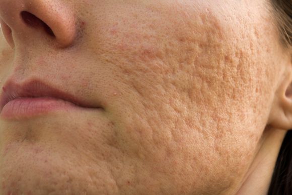 cicatrizes acne
